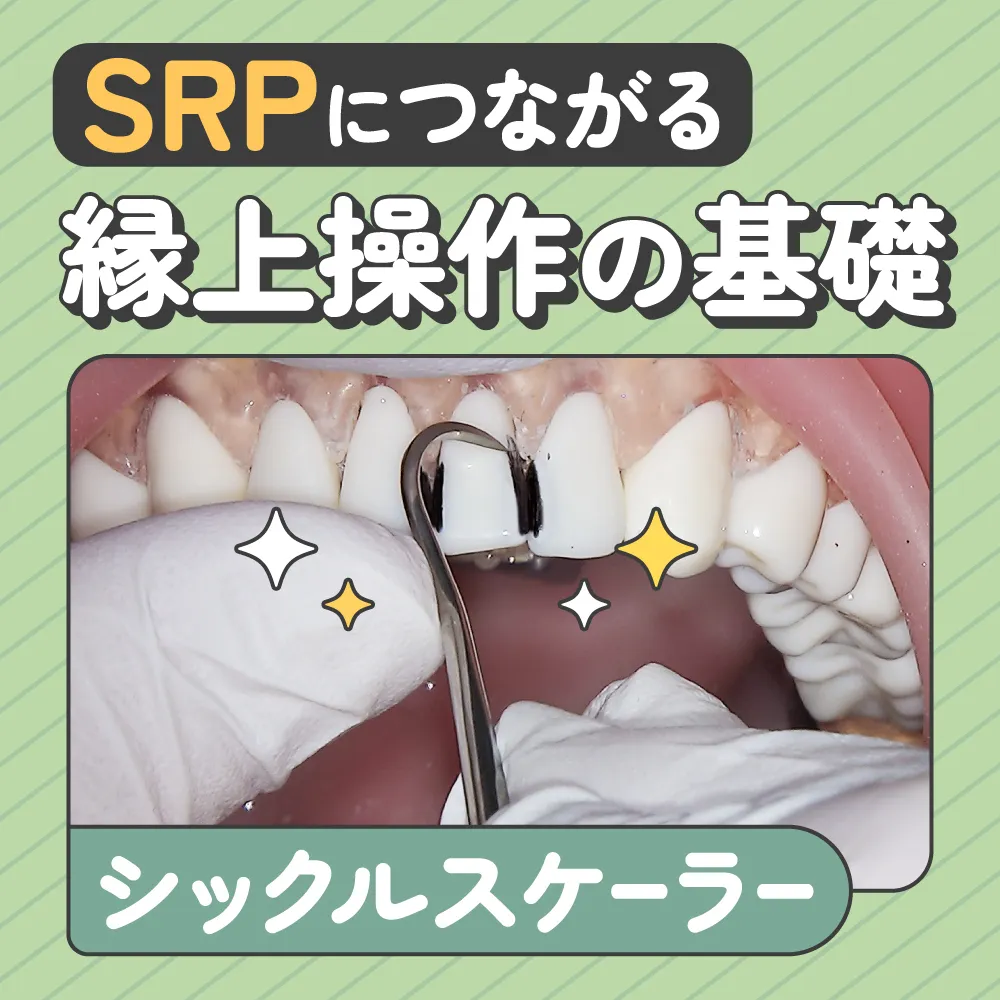 シックルスケーラー