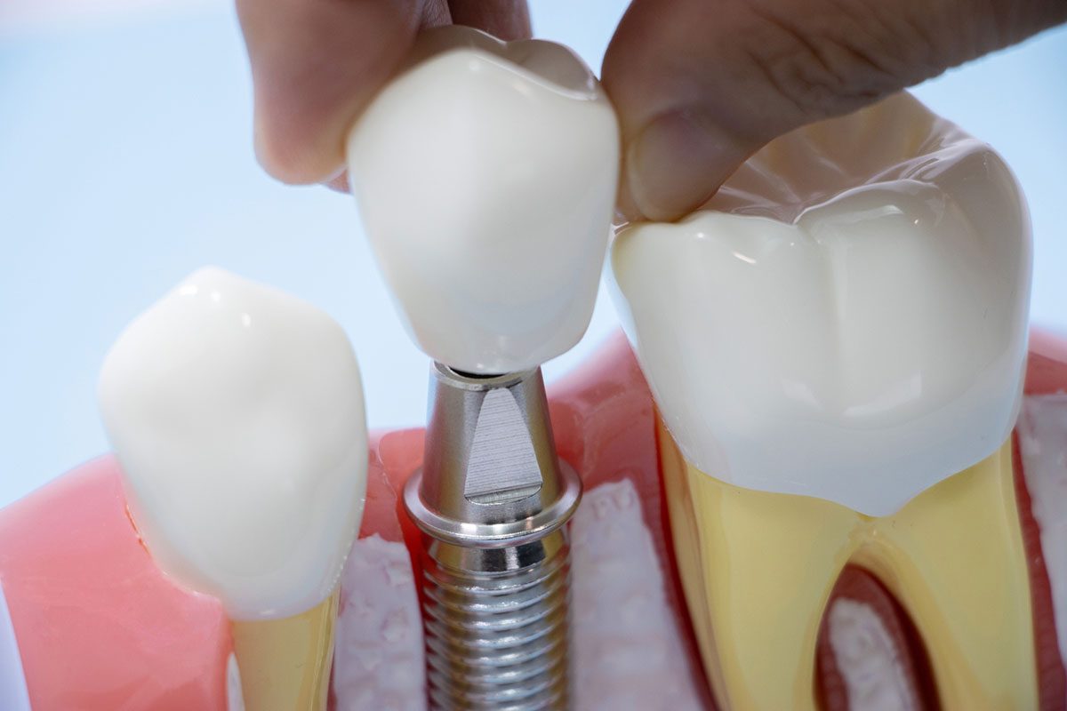 ☆インプラントメインテナンス