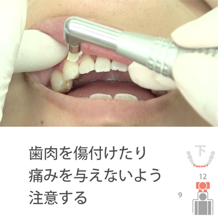 01. 下顎前歯部唇側