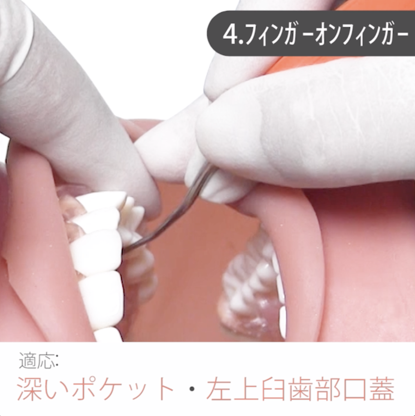 苦手をなくそうSRP 基礎編 09. 固定の取り方 その２