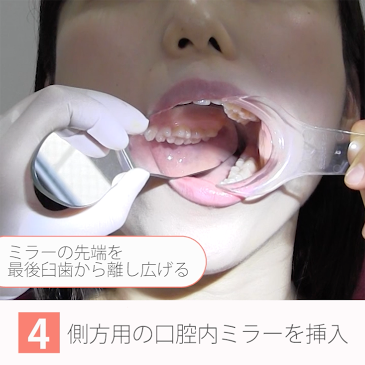 座位で撮る口腔内写真12枚法 11.上顎口蓋側面観の撮影手順
