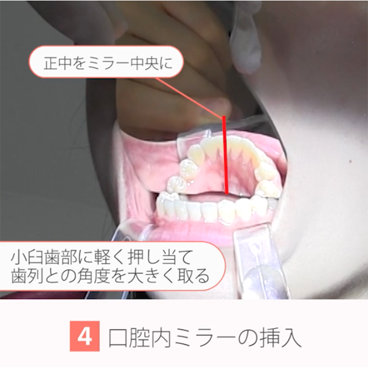 座位で撮る口腔内写真12枚法 18.下顎前歯舌側の撮影手順
