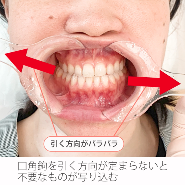 仰臥位で撮る口腔内写真５枚法 03.正面観の撮影ポジションと撮影手順