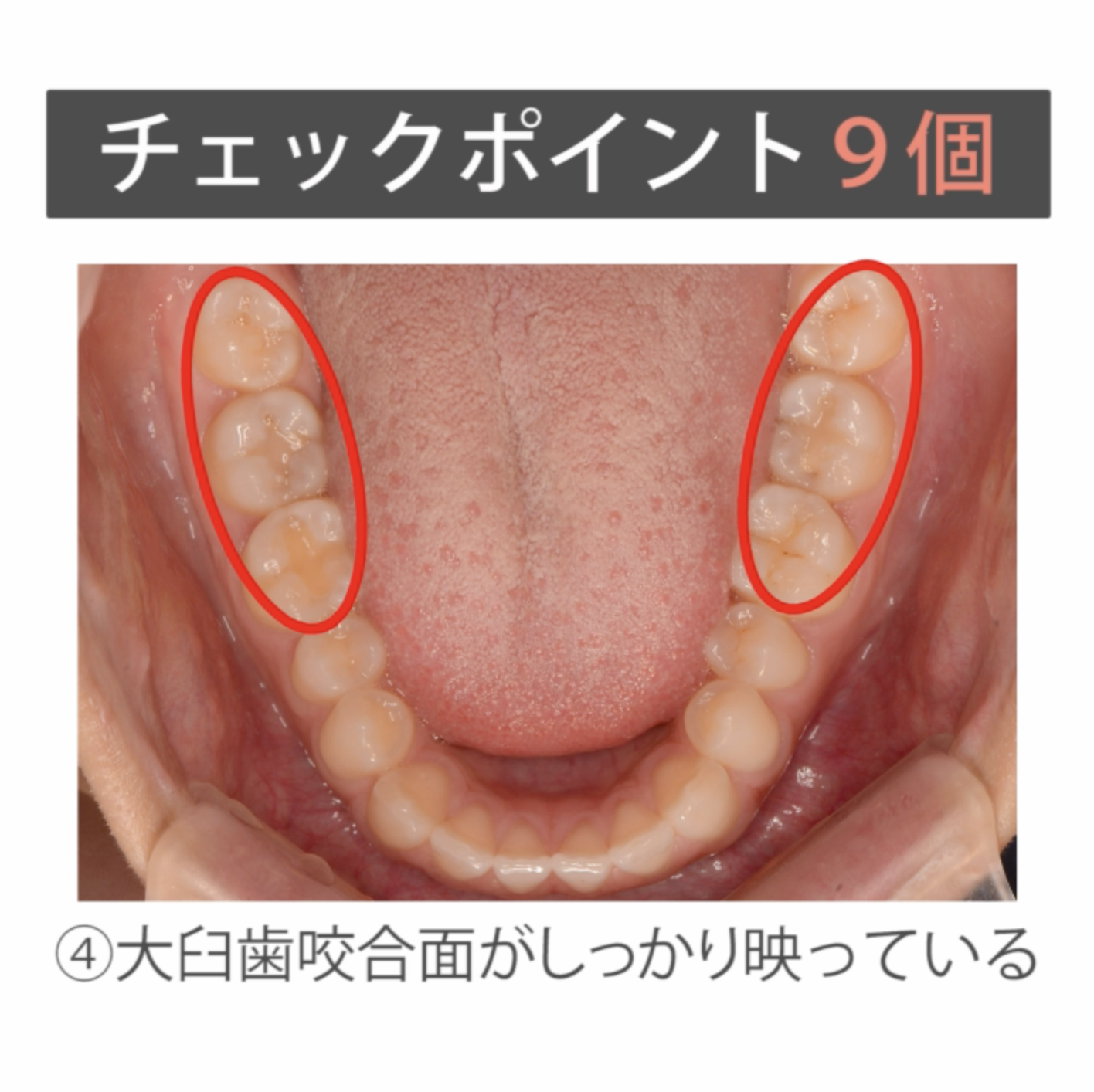 仰臥位で撮る口腔内写真５枚法 07.咬合面観の撮影チェックポイント