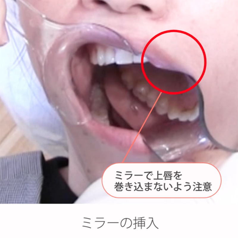 仰臥位で撮る口腔内写真９枚法 06.右上口蓋側面観の撮影ポジションと手順