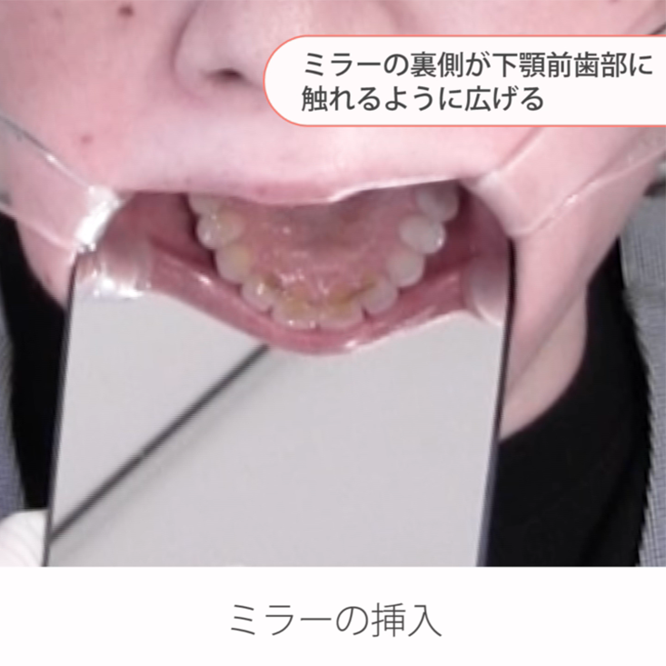 仰臥位で撮る口腔内写真９枚法 12.上顎咬顎合面観の撮影ポジションと手順 