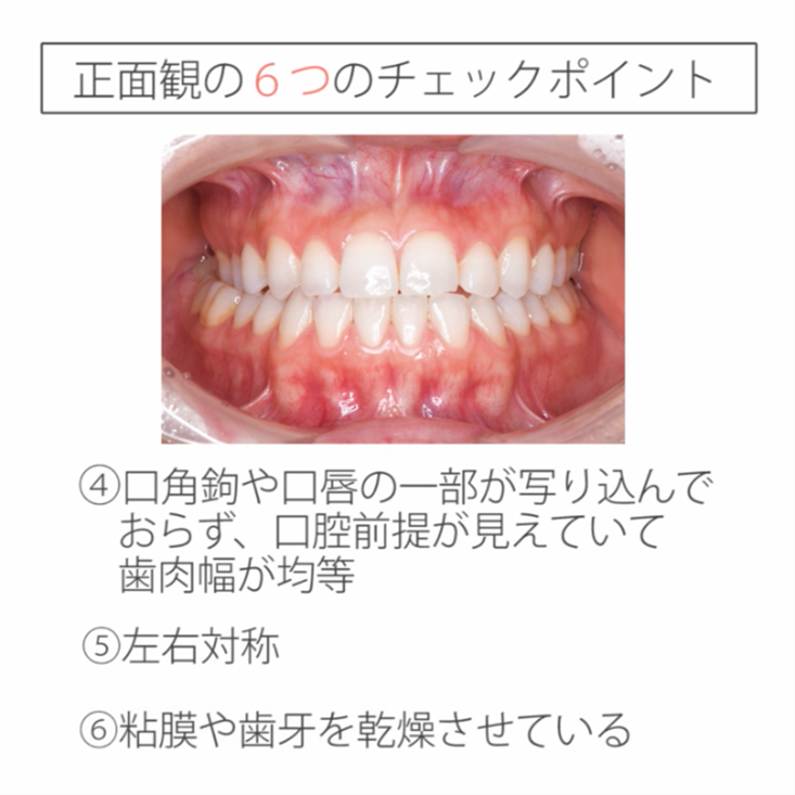仰臥位で撮る口腔内写真12枚法 02.正面観と正面観アップのチェックポイント