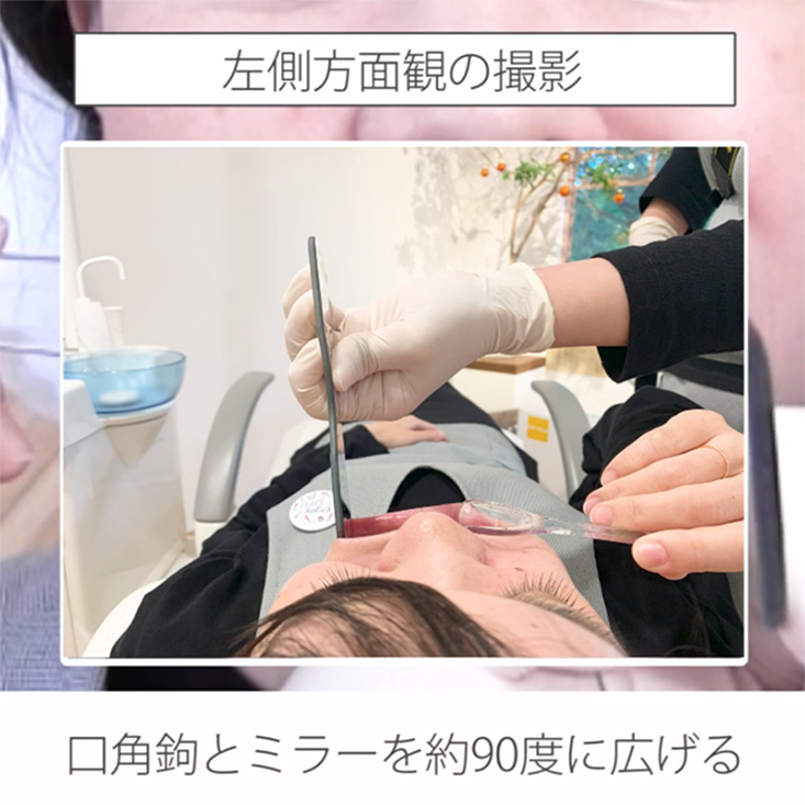 仰臥位で撮る口腔内写真12枚法 08.左側方面観の撮影ポジションと手順 