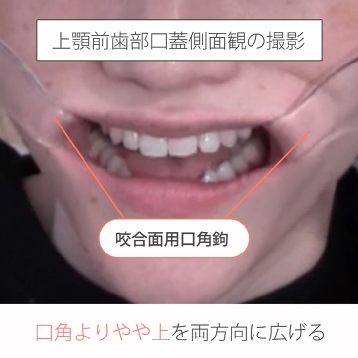 仰臥位で撮る口腔内写真12枚法 13.上顎咬合面観の撮影ポジションと手順 