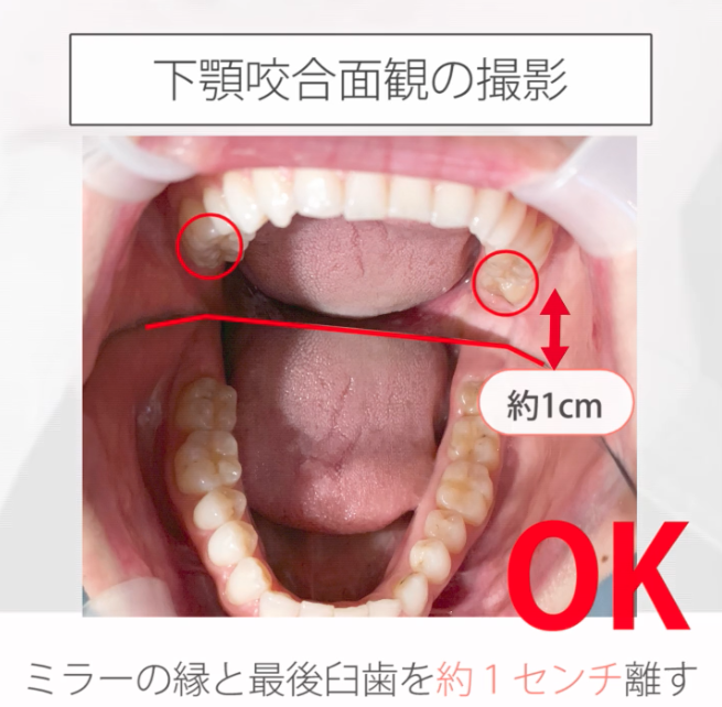 仰臥位で撮る口腔内写真12枚法 15.下顎咬合面観の撮影ポジションと手順 