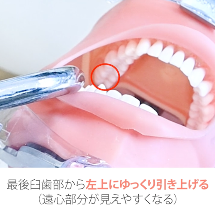 01.左下臼歯部頬側・舌側その1