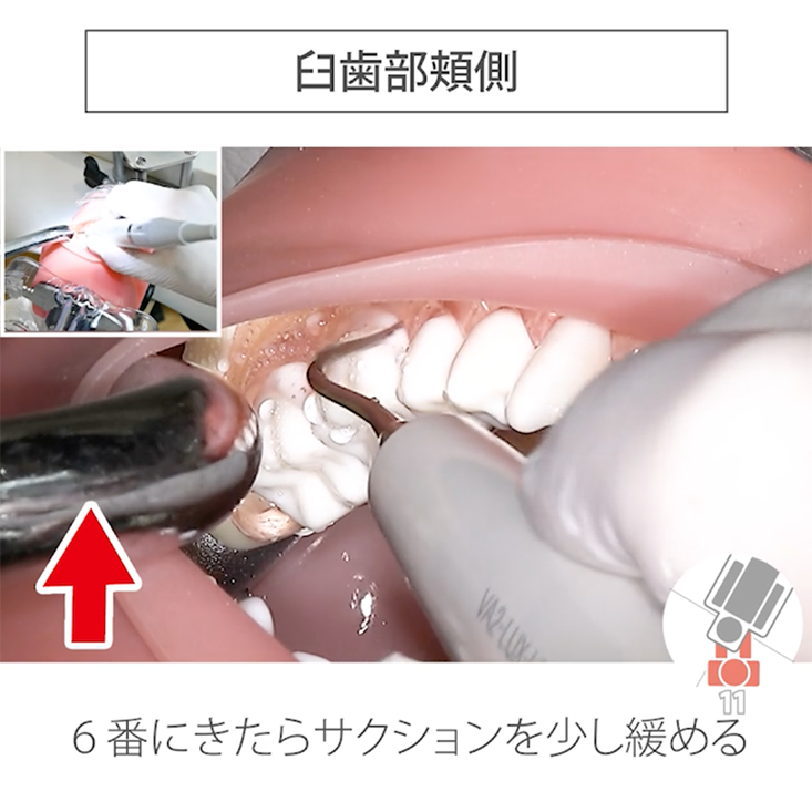 スケーリング実践編 リニューアル版 02.左下臼歯部頬側・舌側その2