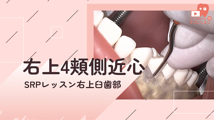 ☆SRPレッスン 右上臼歯部 ☆03.右上4_頬側/近心