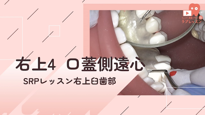 ☆SRPレッスン 右上臼歯部 ☆07.右上4_口蓋側/遠心