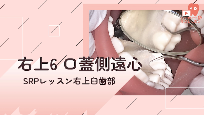 ☆SRPレッスン 右上臼歯部 ☆14.右上6_口蓋側/遠心