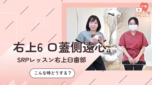 ☆SRPレッスン 右上臼歯部 ☆15.こんな時どうする？-右上6_口蓋側/遠心-