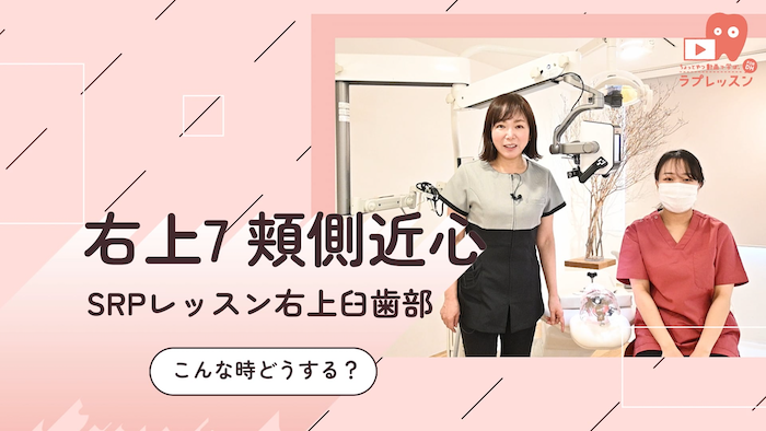☆SRPレッスン 右上臼歯部 ☆17.こんな時どうする？-右上7_頬側/近心-