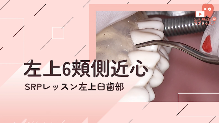 ☆SRPレッスン 左上臼歯部 ☆07.左上6_頬側/近心