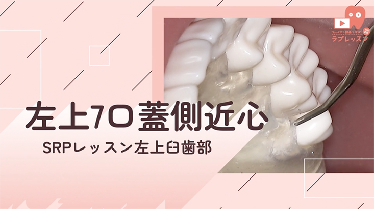 ☆SRPレッスン 左上臼歯部 ☆15.左上7_口蓋側/近心