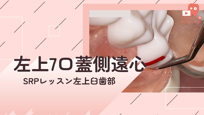 ☆SRPレッスン 左上臼歯部 ☆18.左上7_口蓋側/遠心