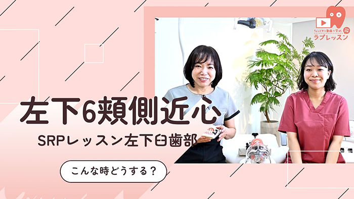 ☆SRPレッスン 左下臼歯部 ☆08.こんな時どうする？-左下6_頬側/近心-