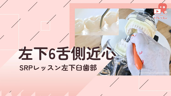 ☆SRPレッスン 左下臼歯部 ☆09.左下6_舌側/近心