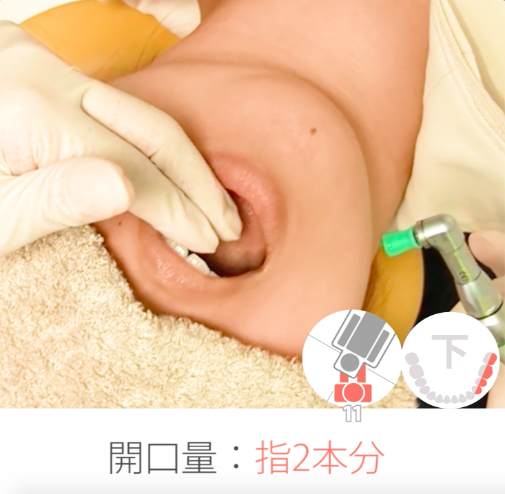 01. 下顎頬側・唇側　その１