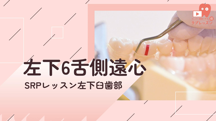 ☆SRPレッスン 左下臼歯部 ☆11.左下6_舌側/遠心