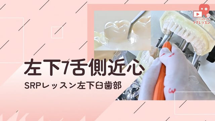 ☆SRPレッスン 左下臼歯部 ☆13.左下7_舌側/近心
