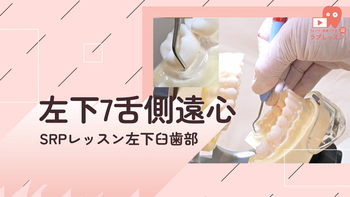 ☆SRPレッスン 左下臼歯部 ☆15.左下7_舌側/遠心