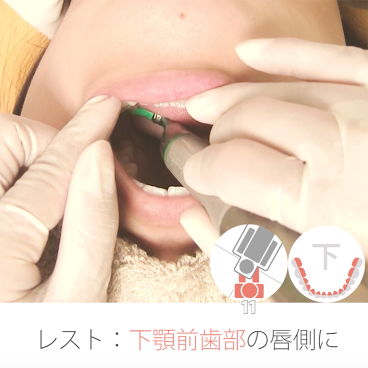 PMTC 実践編 ～ラバーカップ～ 03. 下顎舌側　その１
