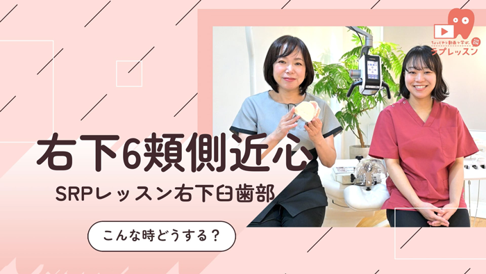 ☆SRPレッスン 右下臼歯部 ☆14.こんな時どうする？-右下６頬側近心 –