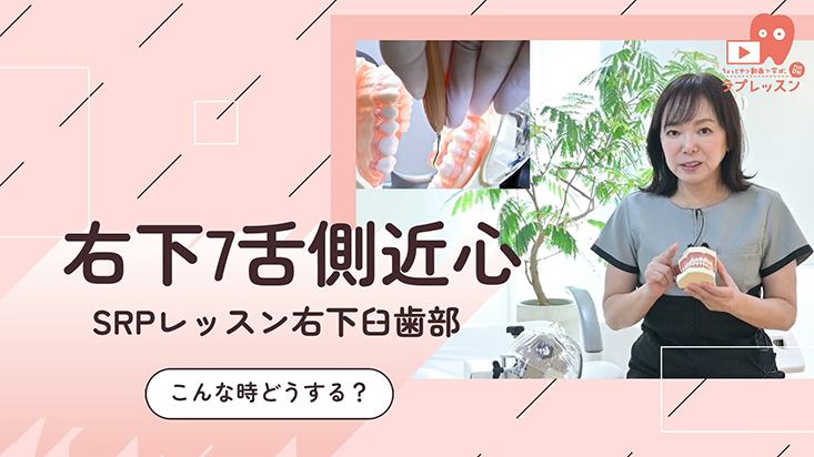 ☆SRPレッスン 右下臼歯部 ☆17.こんな時どうする？-右下７舌側近心-