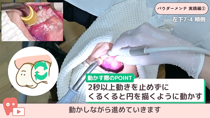 パウダーメインテナンス 実践編 02.左下臼歯部　
