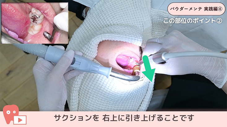 パウダーメインテナンス 実践編 04.右下臼歯部