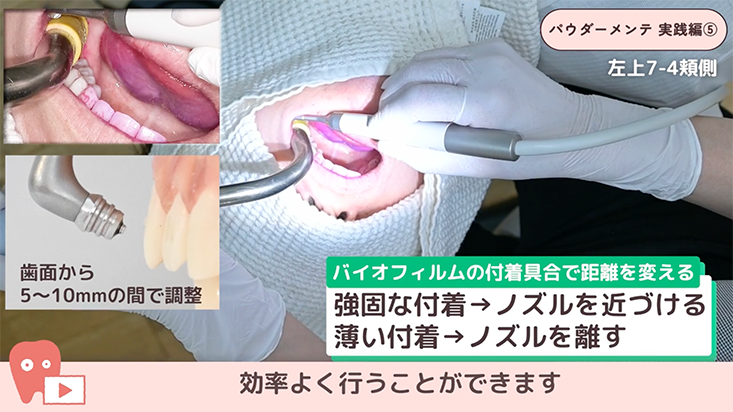 05.左上臼歯部