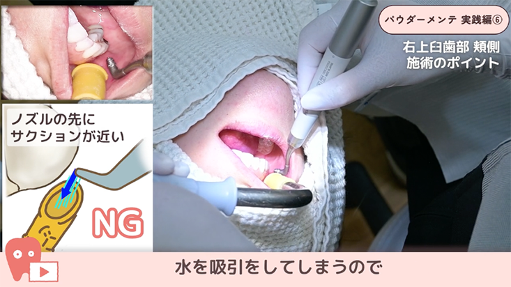 06.上顎前歯部から右上臼歯部 その1