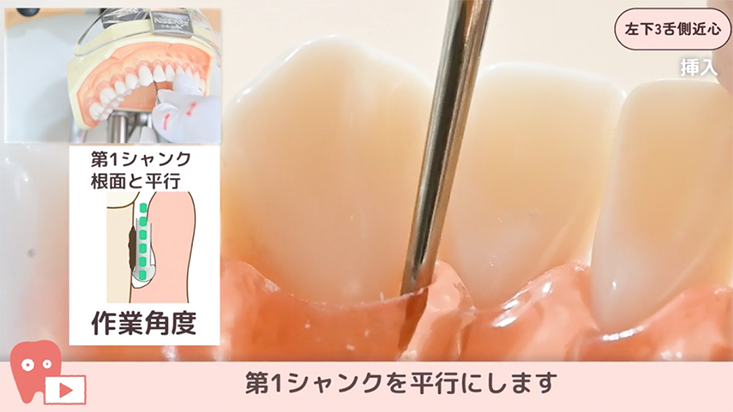 ☆SRPレッスン 下顎前歯部 ☆04.左下３舌側近心