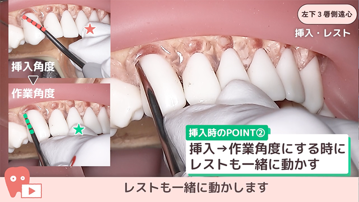 ☆05.左下3唇側遠心