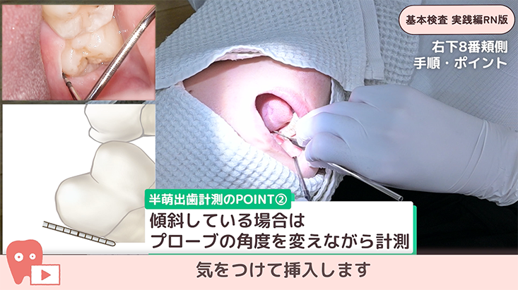 07.症例でみる！右下８半萌出のプロービング