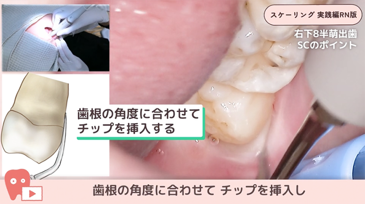 13.症例でみる！右下８半萌出のスケーリング