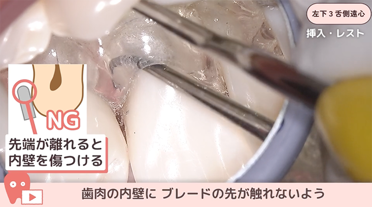 ☆06.左下３舌側遠心