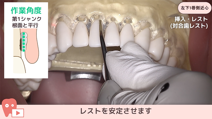 ☆07.左下１唇側近心