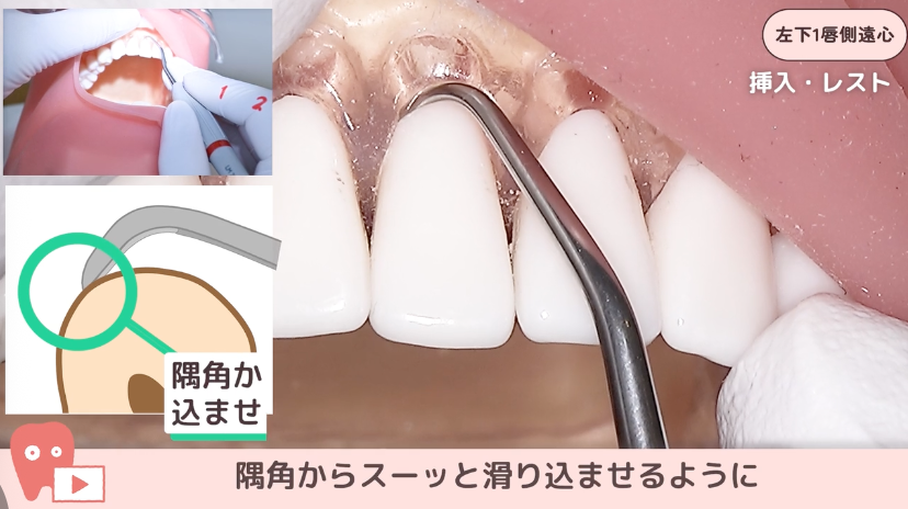 ☆10.左下１唇側遠心