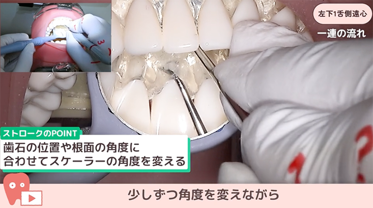 ☆09.左下１舌側遠心