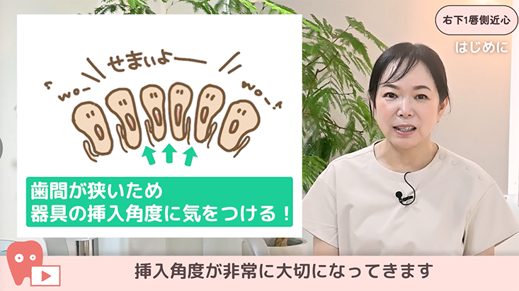 ☆11.右下１唇側近心