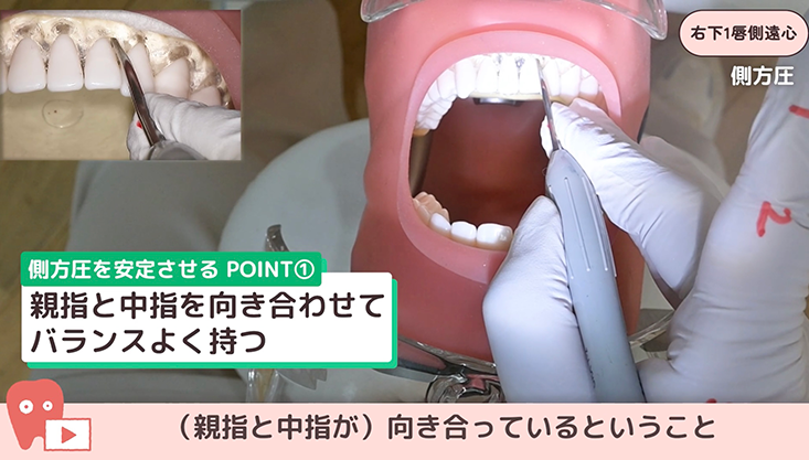 ☆12.右下１唇側遠心