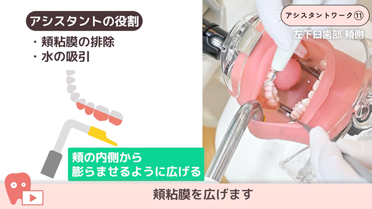 11.超音波スケーリングのアシスト -曲サクション-