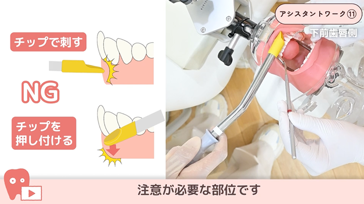 12.超音波スケーリングのアシスト -直サクション-