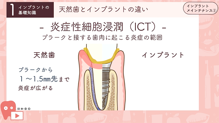 ☆02.-インプラントの基礎知識編② -基本構造 / 天然歯との違い-